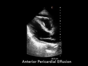 Anterior-Pericardial-Effusion