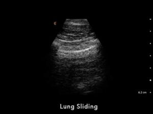 Lung-Sliding