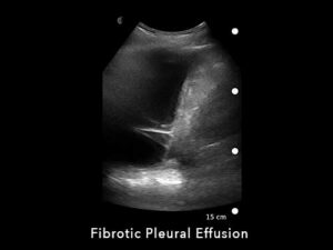 Fibrotic-Pleural-Effusion