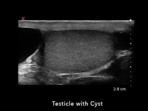 Testicle-with-cyst